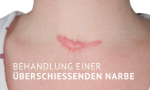 Sichtbare Narbe mit der Unterschrift 'Behandlung einer überschießenden Narbe'